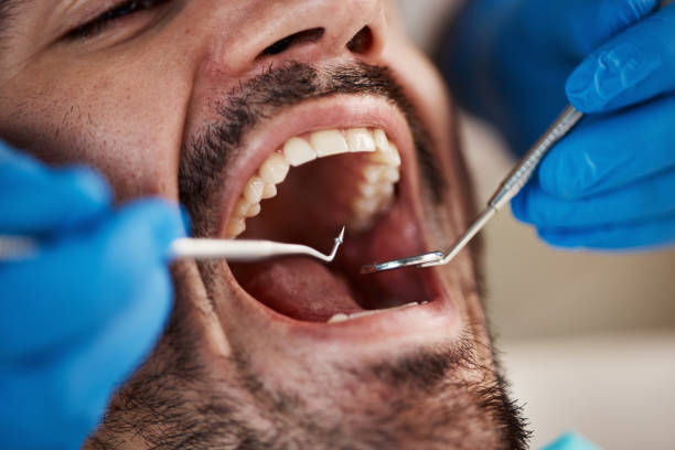 Best Emergency Wisdom Teeth Removal in Alexandria, VA